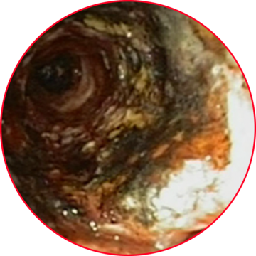 Coagulated granulation tissue