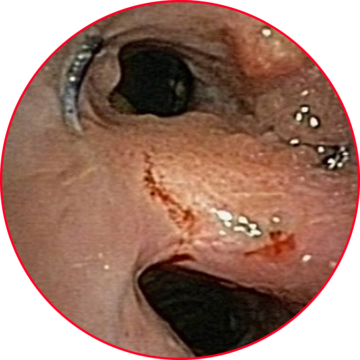 Ingrown Metal Stent